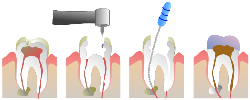Gorgeous Smile Dental - Root Canal