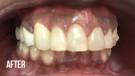 Gorgeous Smile Dental - Crown After 9.1