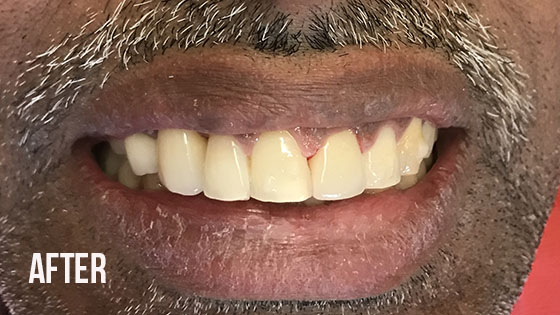 Gorgeous Smile Dental - Crown After 9