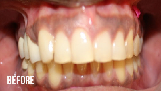 Gorgeous Smile Dental - Crown Before 9.1