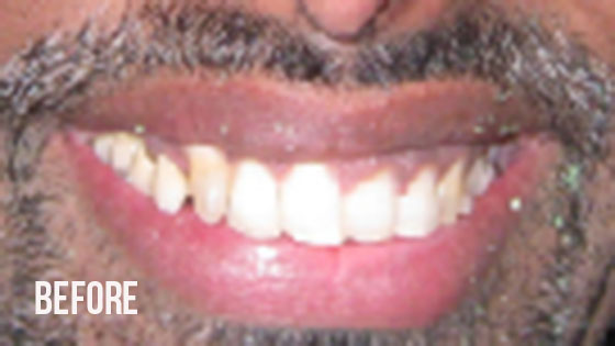 Gorgeous Smile Dental - Crown Before 9