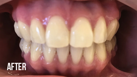 Gorgeous Smile Dental - Invisalign After 4.1