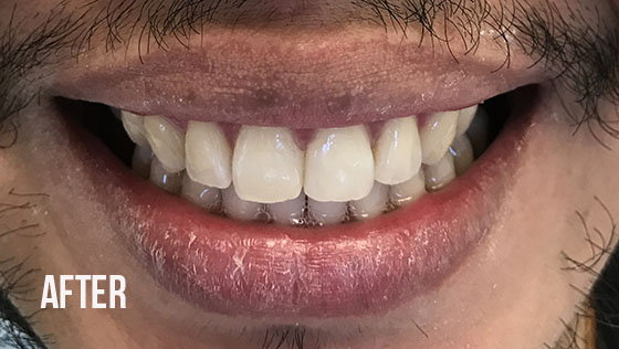 Gorgeous Smile Dental - Invisalign After 4