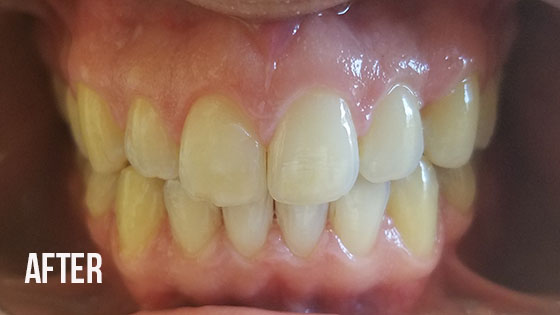 Gorgeous Smile Dental - Invisalign After 6.1