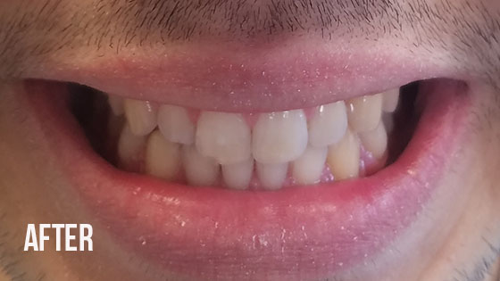 Gorgeous Smile Dental - Invisalign After 6