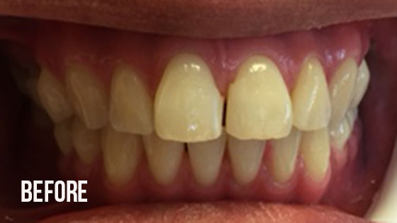 Gorgeous Smile Dental - Invisalign Before 4.1