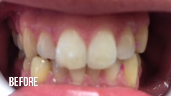 Gorgeous Smile Dental - Invisalign Before 6.1
