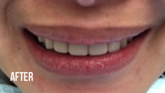 Gorgeous Smile Dental - Lumineers After 1