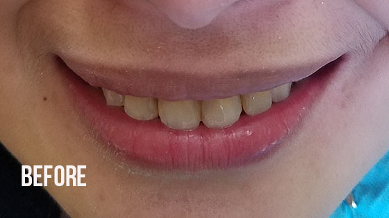 Gorgeous Smile Dental - Lumineers Before 1