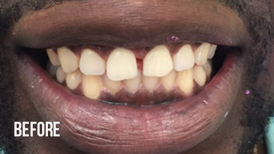 Gorgeous Smile Dental - Lumineers Before 3