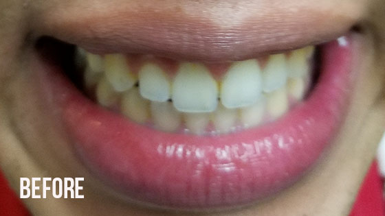 Gorgeous Smile Dental - Lumineers Before 7
