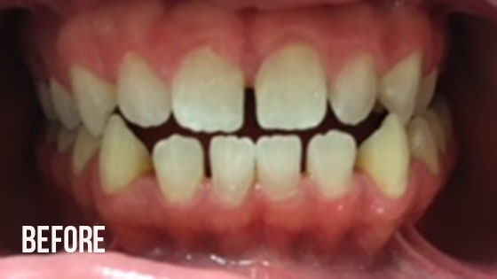 Gorgeous Smile Dental - Lumineers Before 8.1