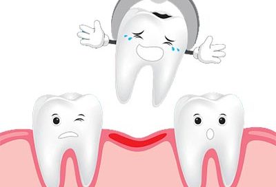 tooth extraction