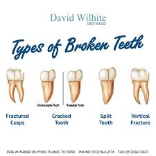 Types-of-Cracked-Tooth.jpg
