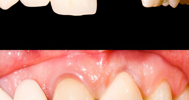 Dental Crowns in California