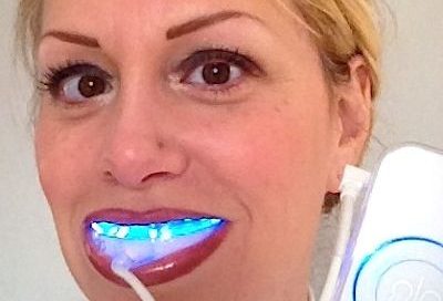 Recommended teeth whitening by your dentist