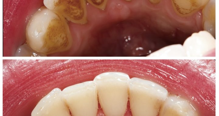 Regular teeth cleaning vs. deep cleaning